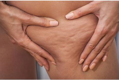 Perché si forma la cellulite e come prevenirla