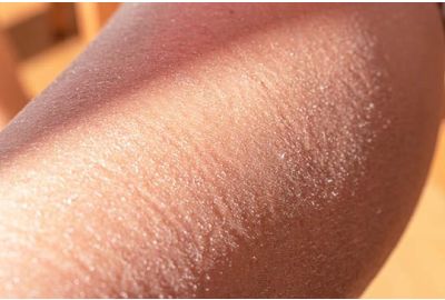 Pelle secca in autunno: come nutrirla dall’interno